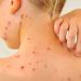 República Dominicana emite alerta epidemiológica por sarampión